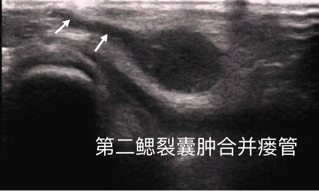 腮腺囊肿超声图片图片