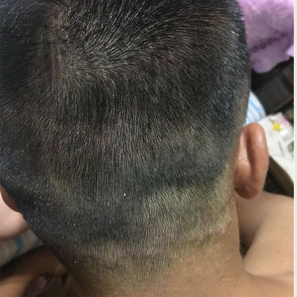 头皮问题产生的原因:头皮屑,头痒和毛囊炎的发生涉及多种复杂的生理和