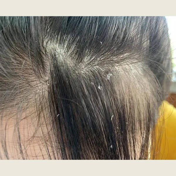 国产洗发水十大品牌_头发_去屑_头皮屑