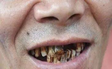 面相变丑,牙齿变黑崩裂,嚼出"槟榔脸"!