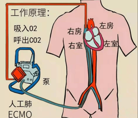 ecmo管路示意图图片