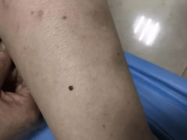 病,新疆出血热,q热,蜱传斑疹伤寒,野兔热,人粒细胞无形体病,巴尔通体