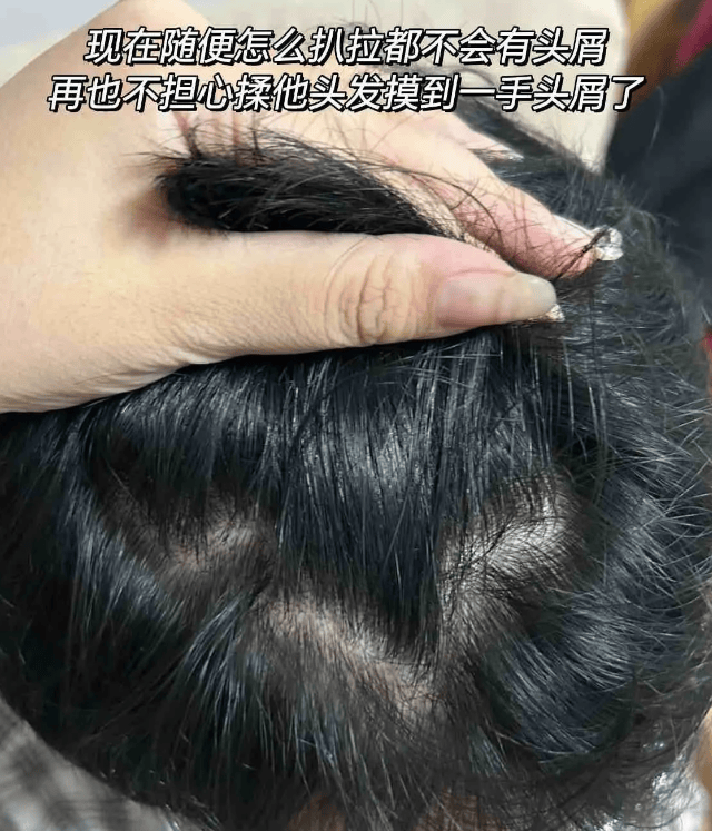 好用去屑止痒洗发水_头发_头皮屑_问题