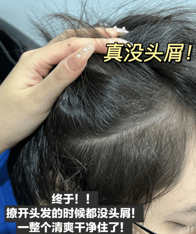 控油止痒去屑洗发水排行榜_头皮屑_成分_头发