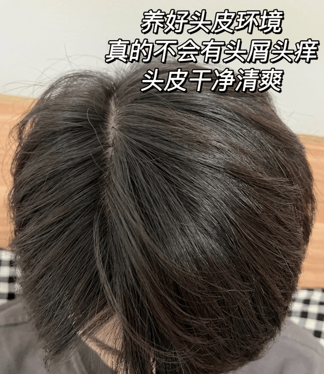 去屑控油止痒洗发水排行榜_头发_问题_成分