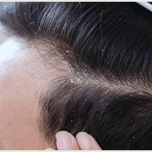 强效去屑洗发露推荐_头皮屑_头发_问题