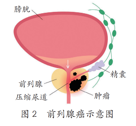 前列腺癌是男言之隐吗