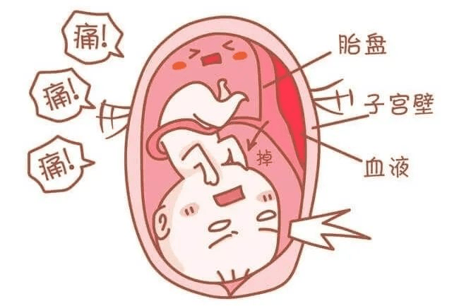 通辽一孕妇发生胎盘早剥