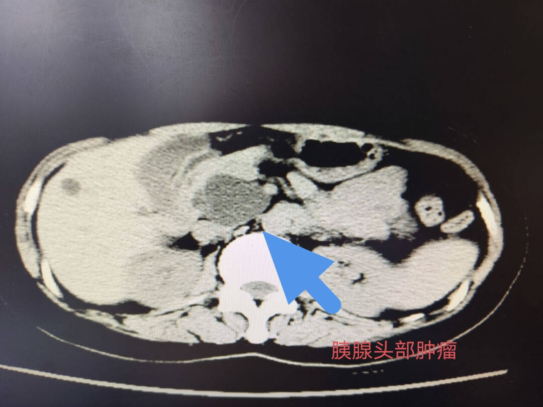 高水平医院建设肇庆市一医院成功实施高难度腹腔镜保留十二指肠胰头