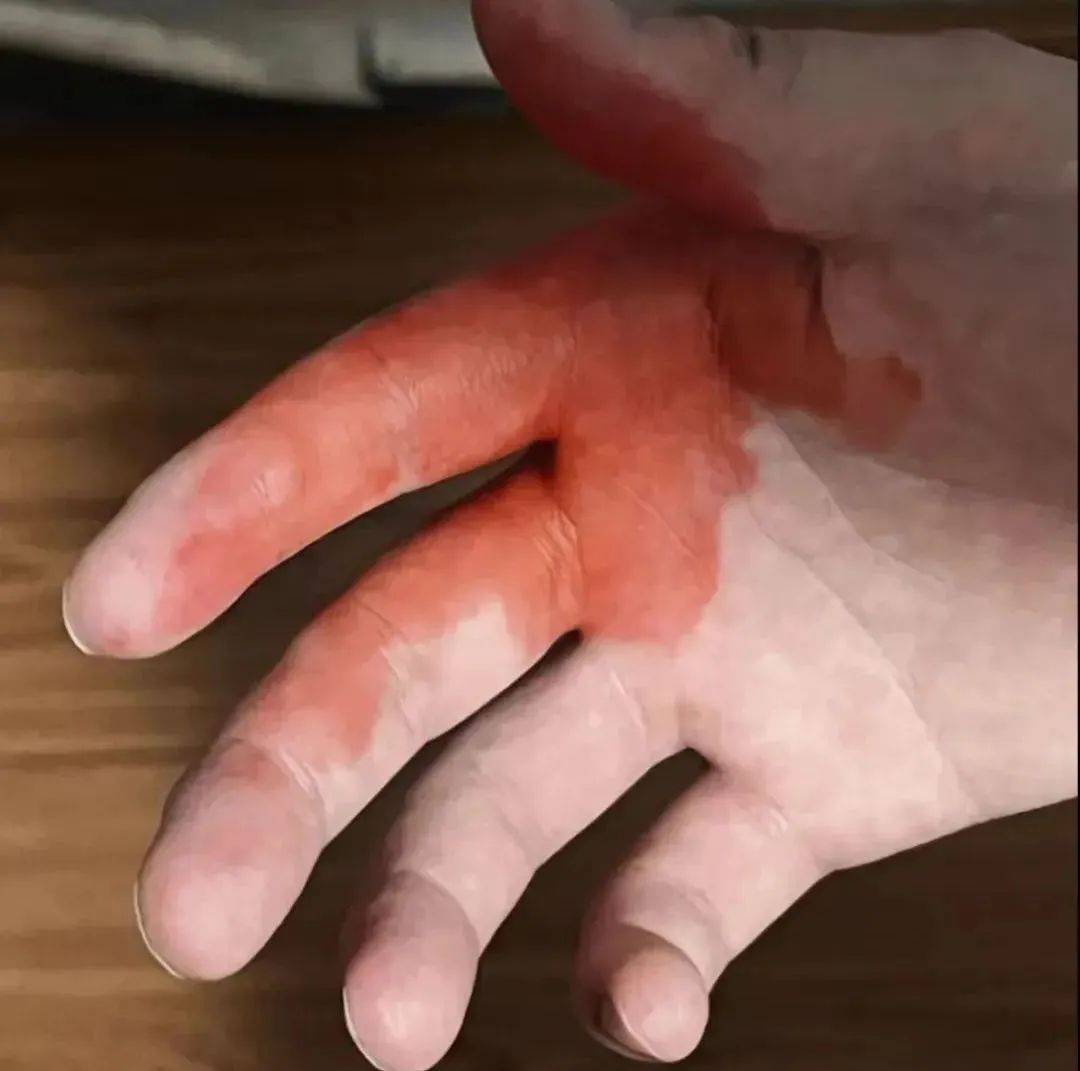 给孩子们涂上一涂爸妈总会拿出红,紫药水小时候磕了碰了再次回到了