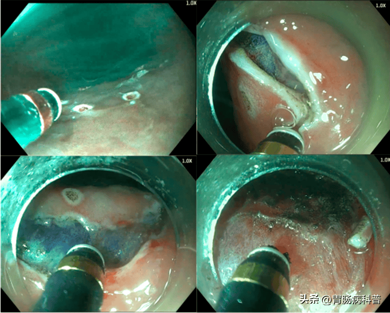 内镜ESD黄金刀图片