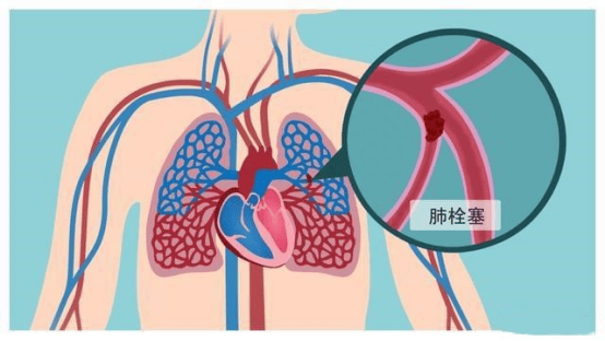 【莫让生命被“栓”住】呼吸二科:血栓是怎么形成的?(上篇)_血管_疾病_治疗