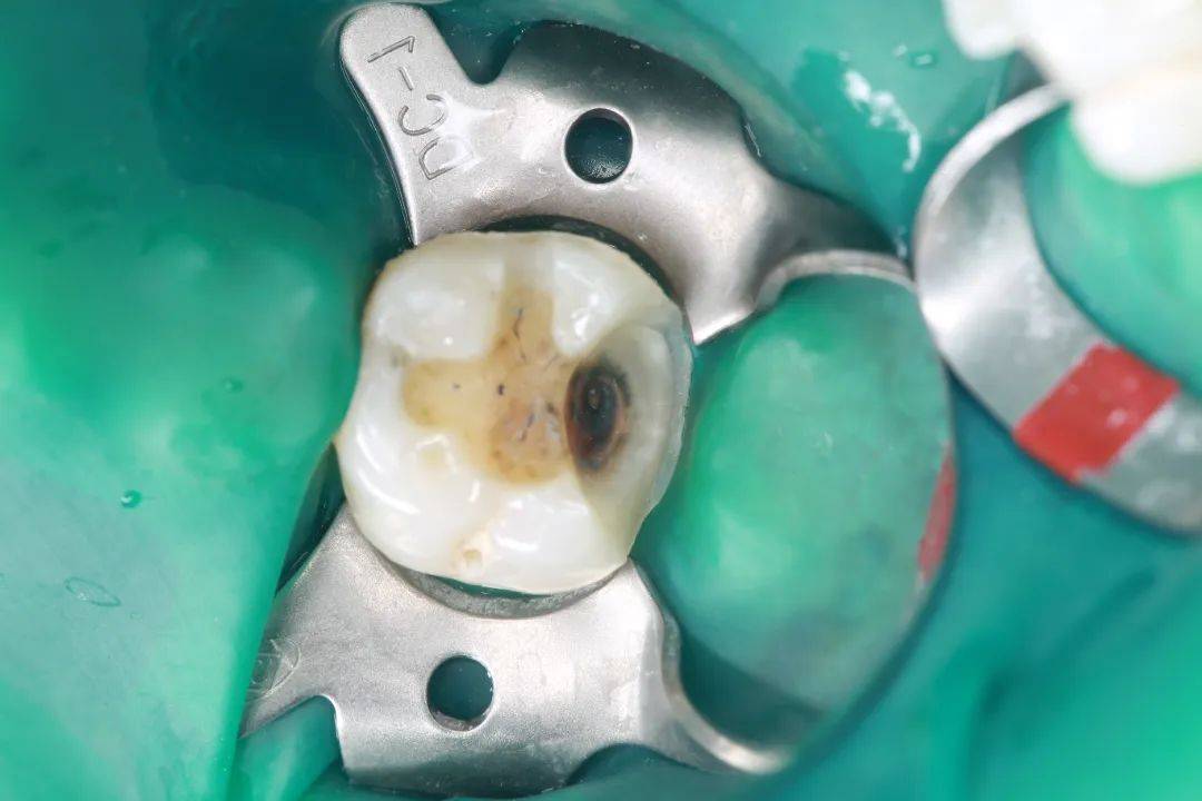 临床适应症二:树脂充填前窝洞彻底清洁02"除表面粗糙度外,基牙预备体