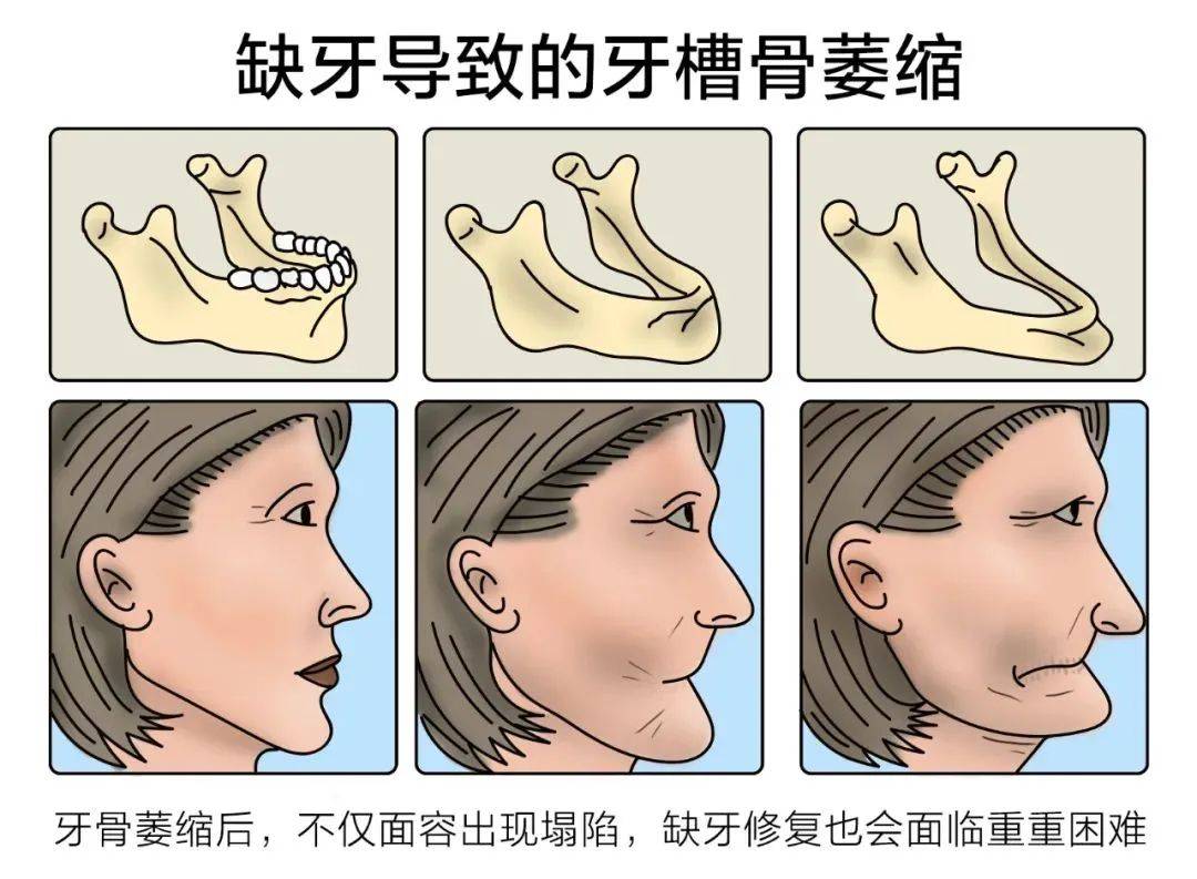 牙齿坏处图片