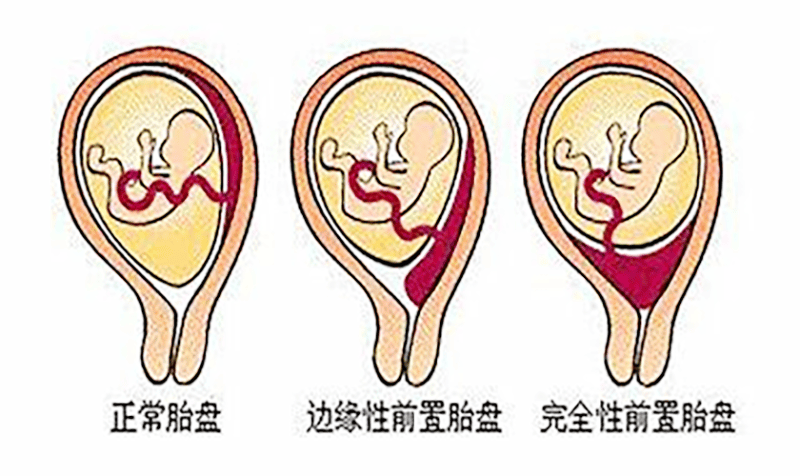 完全性前置胎盘图片图片