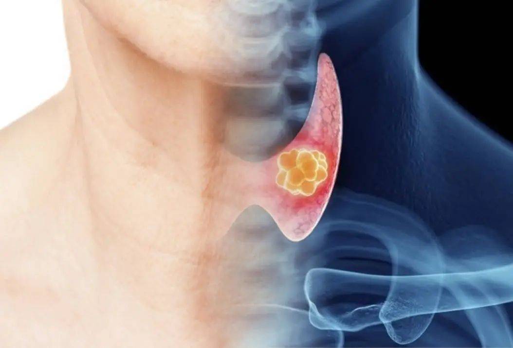 甲状腺癌患者数量也