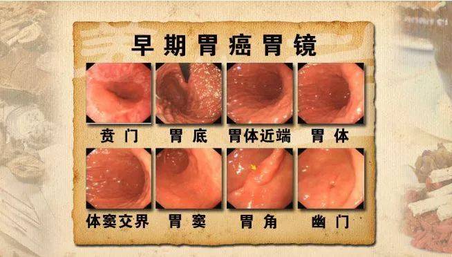 深圳一年新增超4 5万例 最新癌症榜公布