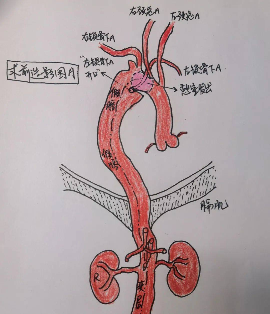 右回旋支图片