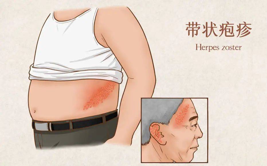 带状疱疹为什么总盯上老年人