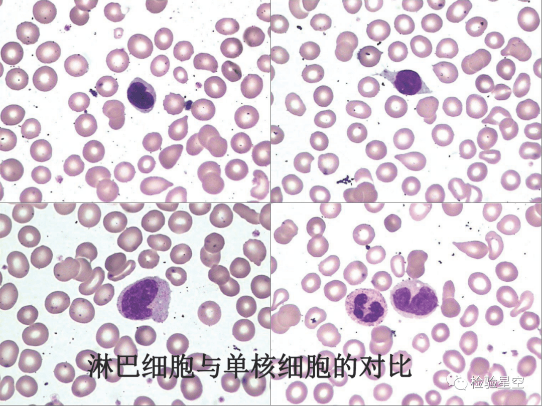检验人爱的干货!血细胞典型形态学图谱(118张)