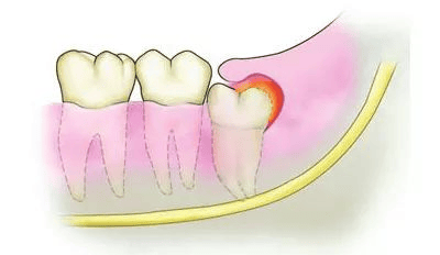 科普 智齿的危害