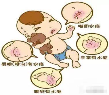 手足口病来袭,家有孩童请注意_儿童_传播