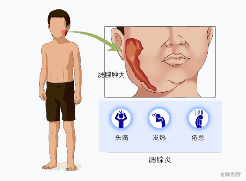 儿童急性腮腺炎图片图片