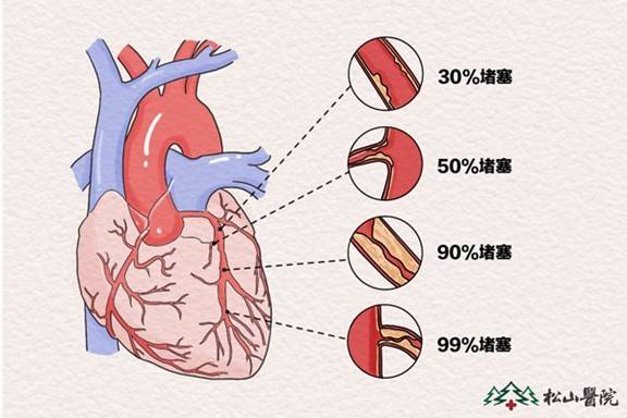 血管堵塞程度图片