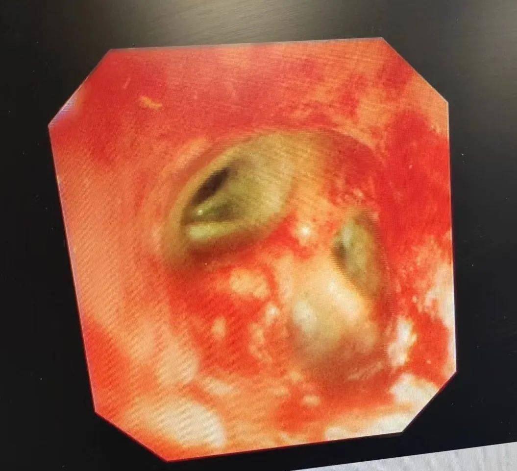 图2 术中取出的支气管内结石图1 支气管镜见右肺中叶内侧段走行区高