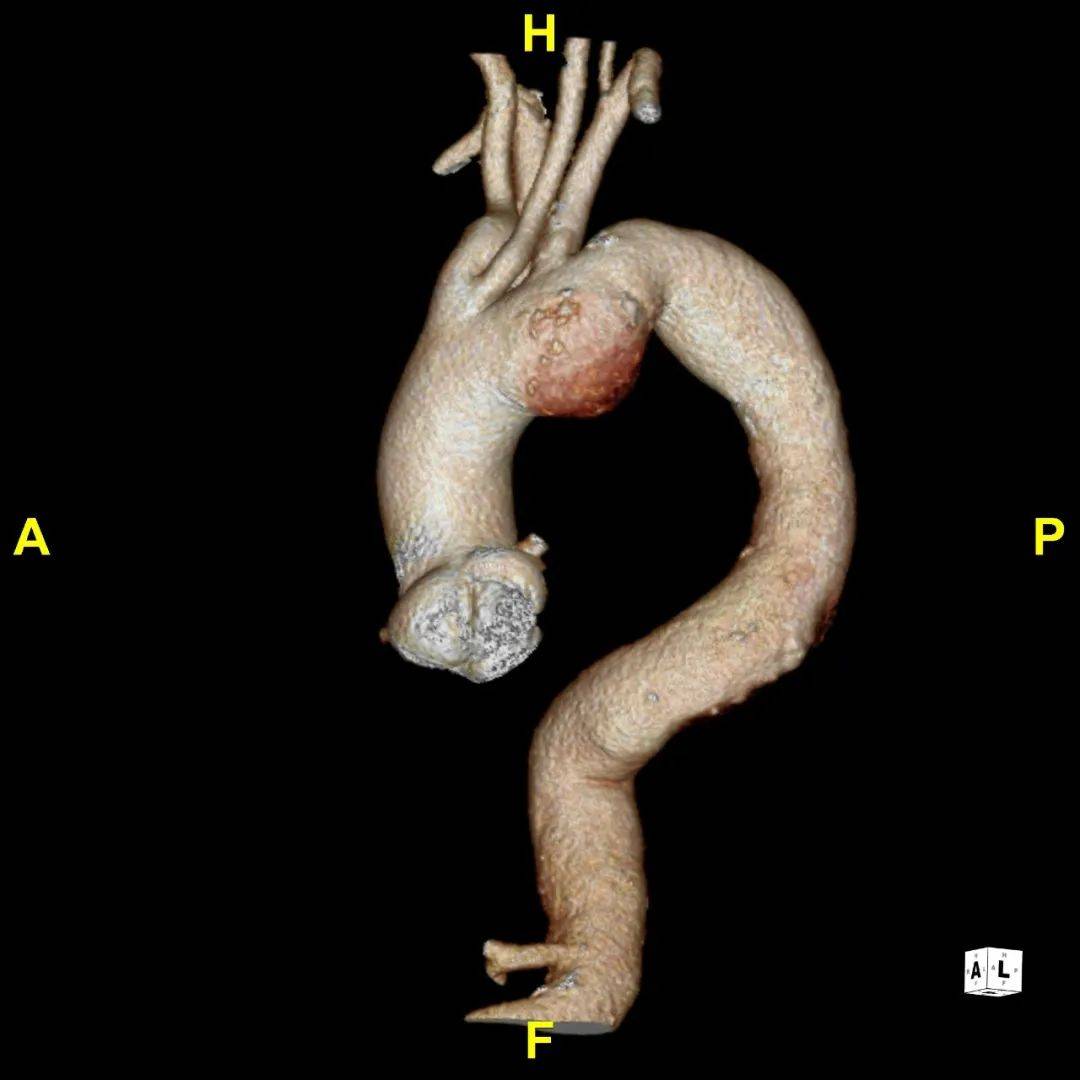 主动脉弓缩窄手术图片