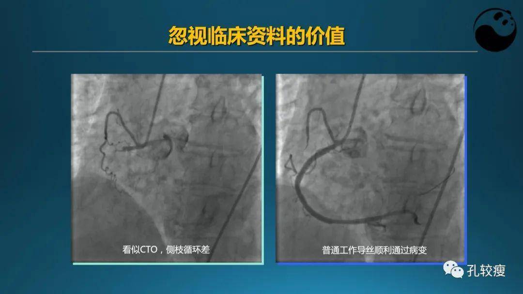 从零开始,教你全面剖析冠脉造影结果!_血管_四川省_中国