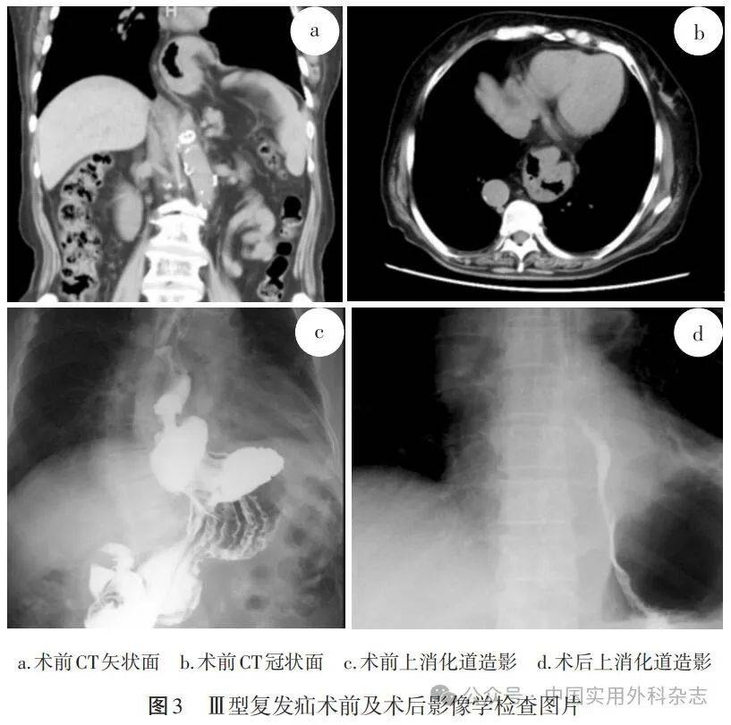 食管裂孔疝是什么病图片