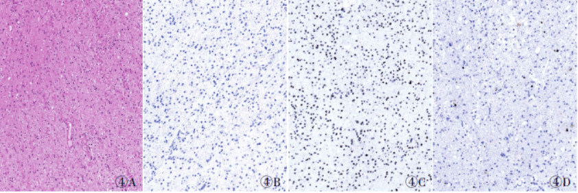 伴IDH1 R82K突变的复发性胶质瘤1例并文献复习