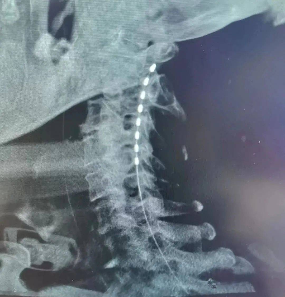 品驰特约 | 专访辽宁省人民医院黄海韬:积累数十例