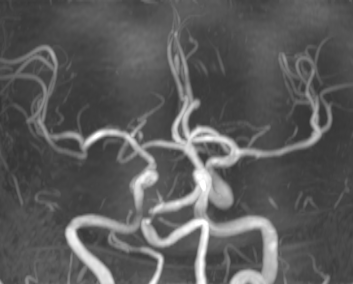 fastunnel输送型球囊扩张导管治疗基底动脉重度迂曲扩张伴狭窄一例