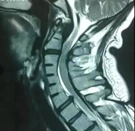 2/3伴脊柱侧弯,半椎体,脊椎分节不全,隐裂或颈肋.