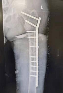 依据子午流注循经行腹部按摩,联合中药热奄包四子散热敷腹部,大黄降浊