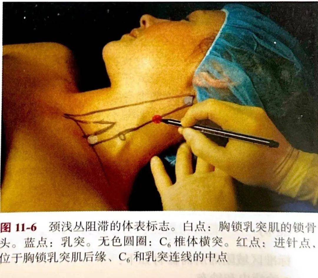 顽固性呃逆的诊疗技巧—附罕见病例精析