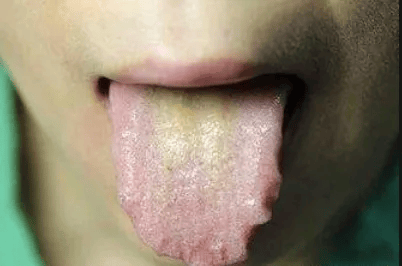舌头根部长了肉粒图片