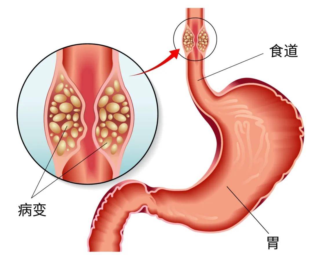 吃出来的癌症:食管癌