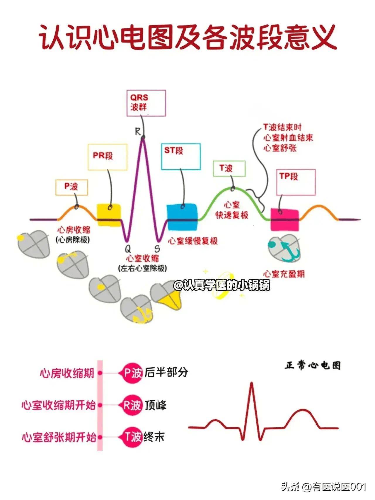 各种心电图的记忆口诀图片