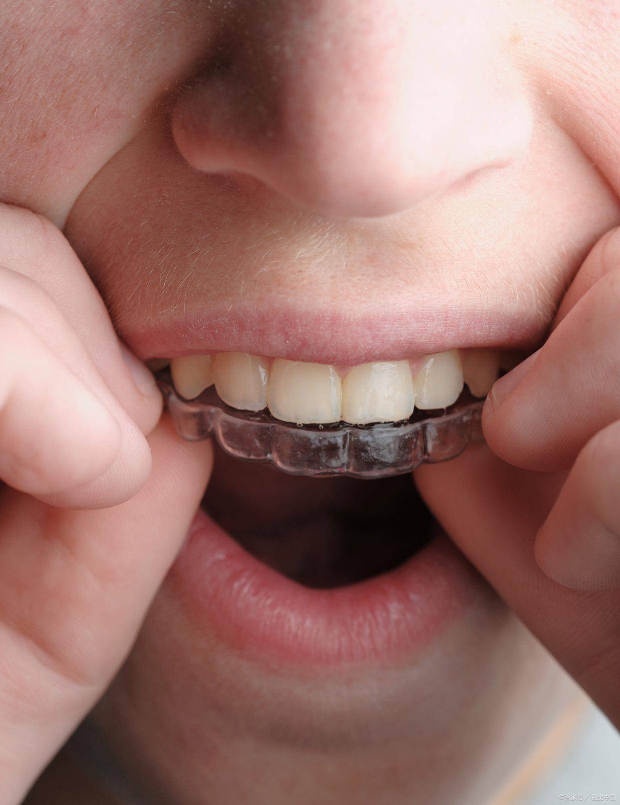 两岁半幼童竟每天戴 12 小时牙套,儿童牙齿矫正乱象何时休