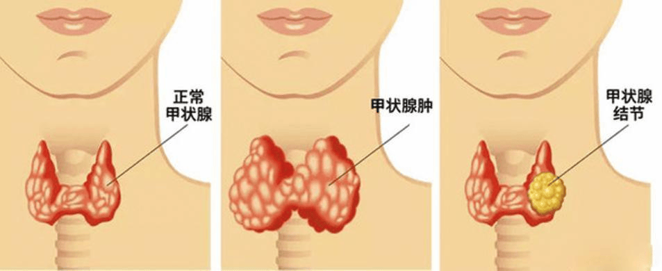 体检发现甲状腺结节?别怕