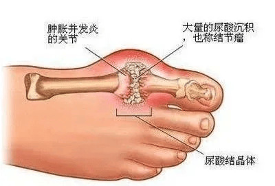 痛风,不是一种病,是一串病