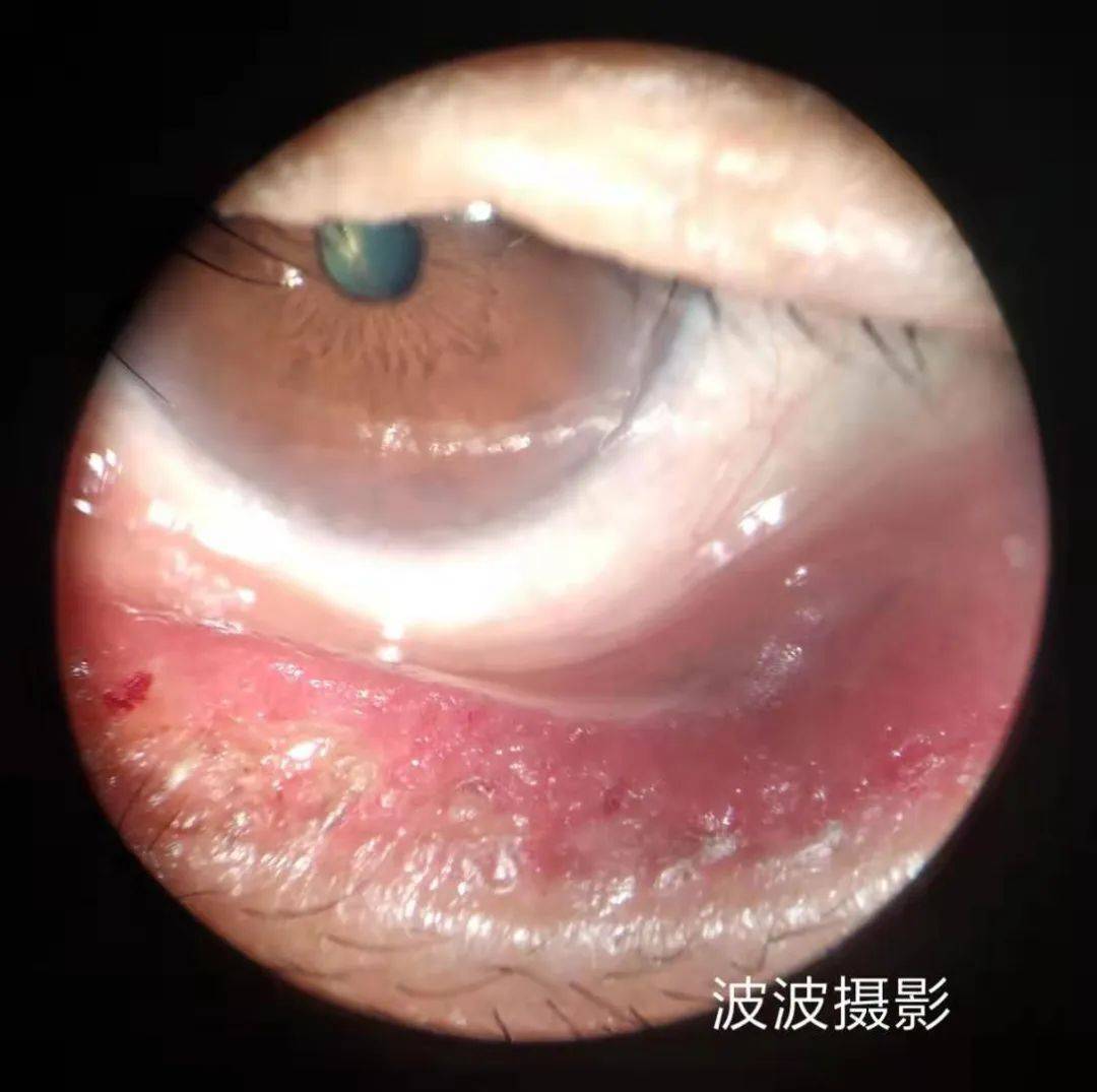眼科图谱100张 | 裂隙灯下眼科图片分享_角膜_秘籍_医生