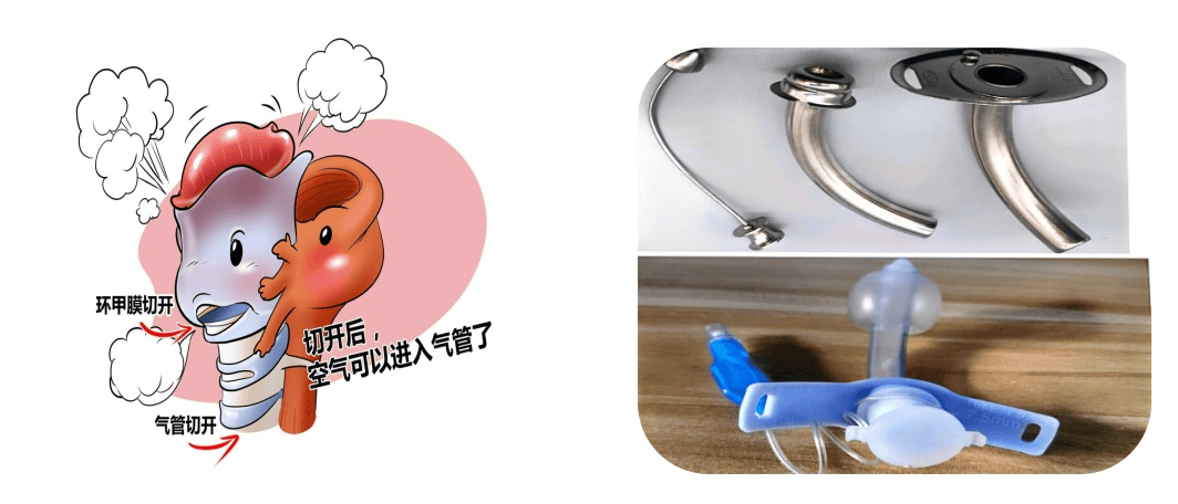 科普|气管切开时你该签字同意吗?_医生_肺部_因为