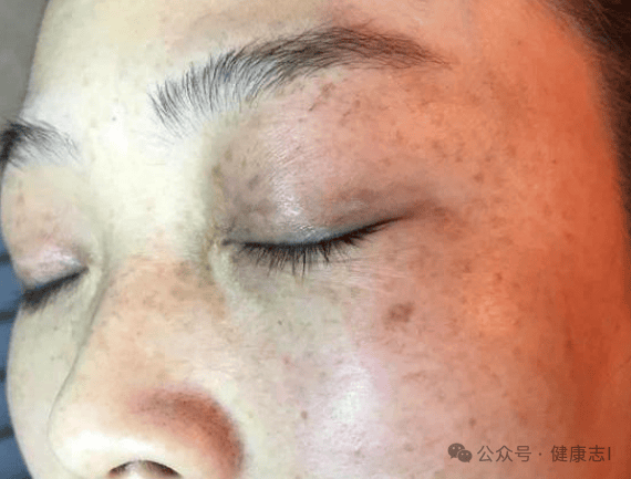 血脂高,"脸"先知?医生提示:假如出现5种症状,最好去检查