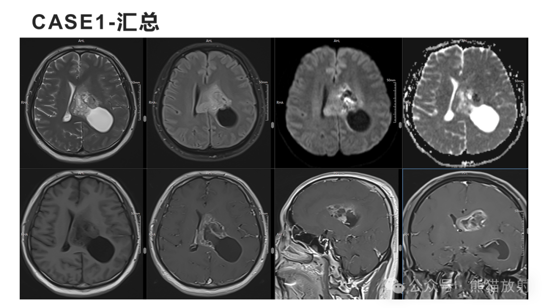 侧脑室肿瘤图片