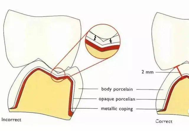 牙医备牙常常忽视了这些导致失败修复体的因素!