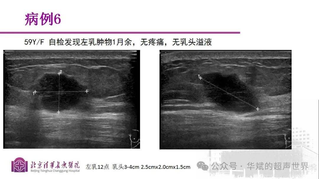 病例讨论与文献复习61乳腺包裹性乳头状癌(epc)